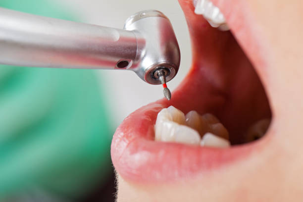 Best Broken or Chipped Tooth Repair in Colfax, IA